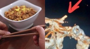 A Vietnamese man complained of a headache and did not know that he had chopsticks in his skull (3 photos)