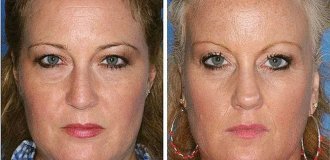 The visible effects of smoking as seen in identical twins (5 photos)