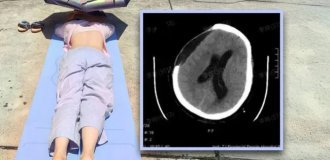 In China, woman falls into coma after "therapeutic" tanning (2 photos)