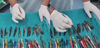 В Индии хирурги извлекли из желудка мужчины 29 ложек, 19 зубных щеток и 2 ручки (2 фото + 1 видео)