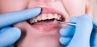 Самолігуючі брекети і дикція: чи змінюється мова і як швидко адаптуватися