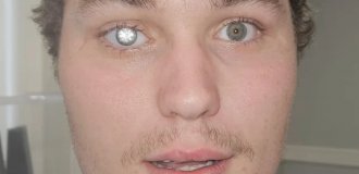 A jewelry store owner inserted a 2-carat diamond into his eye (5 photos + 1 video)