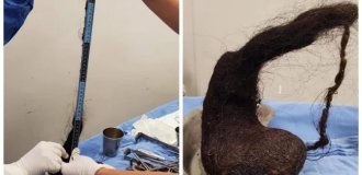 Потеряла  в весе и страдала от депрессии: медики обнаружили  в желудке трехлетней девочки огромный волосяной комок (3 фото)