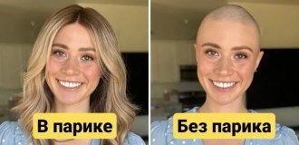 With and without a wig: women with alopecia who were able to overcome their complexes (12 photos)