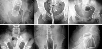 Експерти склали рейтинг речей, які застрягли у різних отворах людей у ​​2025 році (5 фото)