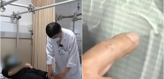 A 35-year-old Chinese man broke his femur as a result of coughing (3 photos)