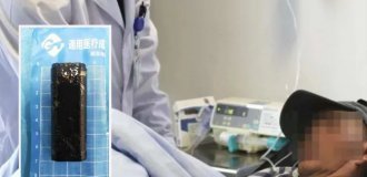 Врачи извлекли зажигалку из желудка мужчины, который в пьяном угаре проглотил её 30 лет назад (5 фото)
