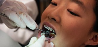 Fake braces – Asian understanding of beauty (6 photos)