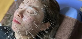 Fashionable Acupuncture Technique Turns People Into Porcupines (5 photos)