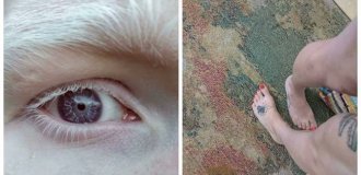 Six Fingers on Both Hands, Violet Eyes, and Other Unique Physical Traits of Real People (23 photos)
