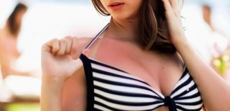 Terrible Advice: Popular Sunburn "Hacks" You Should NEVER Try (7 Photos)