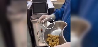 Медики извлекли десятки камней из мочевого пузыря любителя сладкой газировки