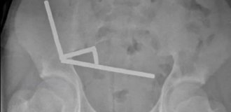 Teenager swallowed 100 magnets and lost part of his intestines (3 photos)