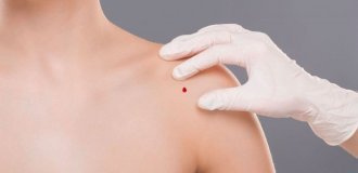 Почему появляются ангиомы во взрослом возрасте?