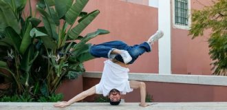 A breakdancer who constantly spun on his head earned himself a bald spot and a growth on his skull (2 photos)