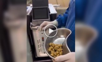 Медики извлекли десятки камней из мочевого пузыря любителя сладкой газировки