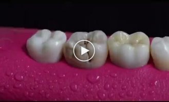 How to treat a tooth for caries with nerve removal