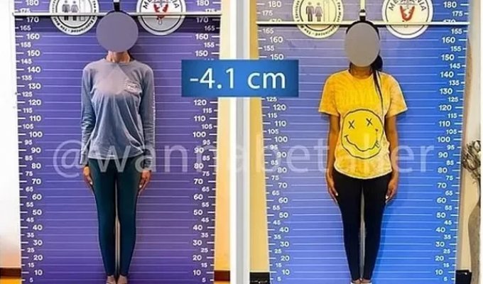 Модели больше не в моде? Зачем женщины делают операции по укорачиванию ног (6 фото)