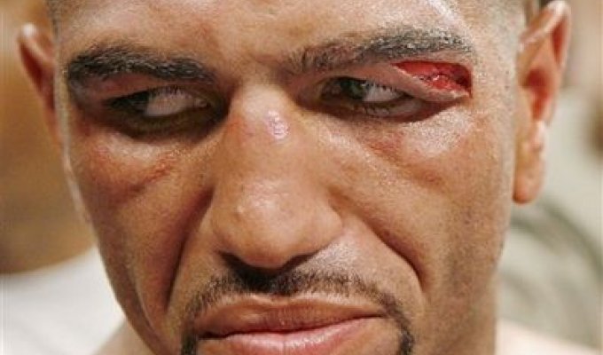  Боксерские травмы (13 Фото)