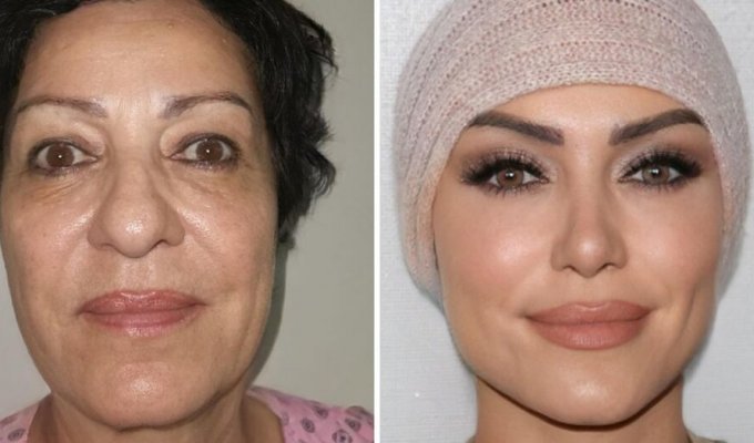 16 shocking works of Turkish surgeons who literally give a new appearance to their patients (17 photos)
