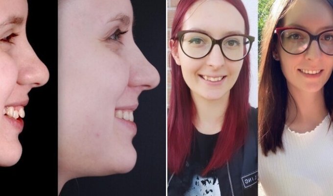 14 людей, які вирішили змінити свою посмішку - і не помилилися (15 фото)