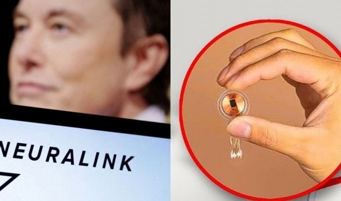 Elon Musk's company implanted an implant into the human brain for the first time (4 photos)