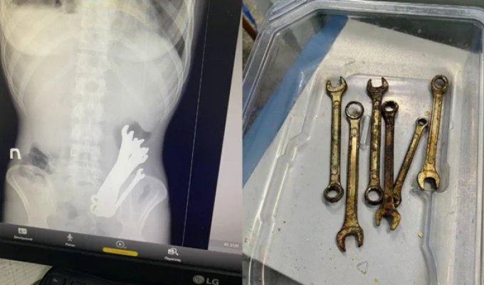 Ukrainian swallows six wrenches on a dare (3 photos)