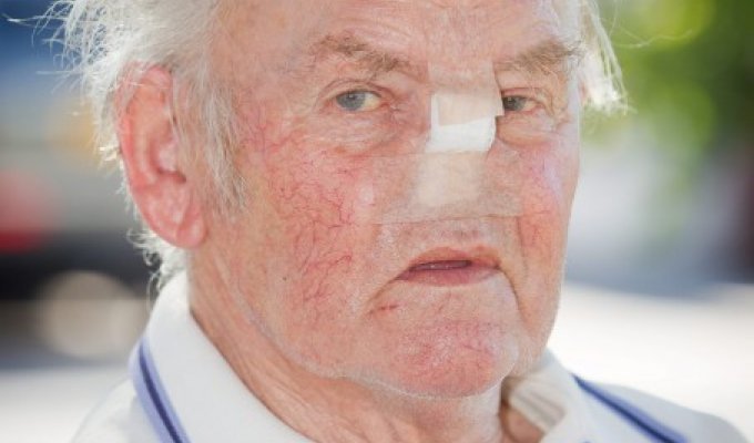 Пенсионер потерял свой нос у зубного врача (4 фото)
