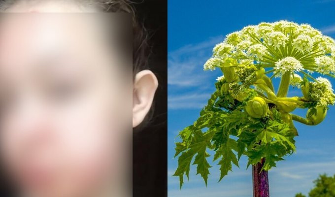 A victim of botany: the girl was walking around the field and wanted to eat rhubarb, but it turned out to be hogweed (6 photos)