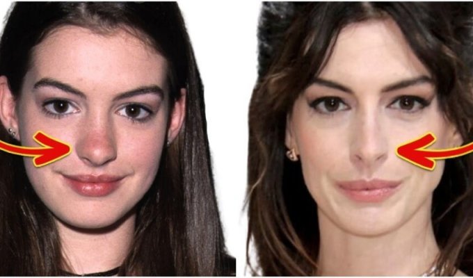 16 stars who do not hide the fact that they had rhinoplasty (17 photos)