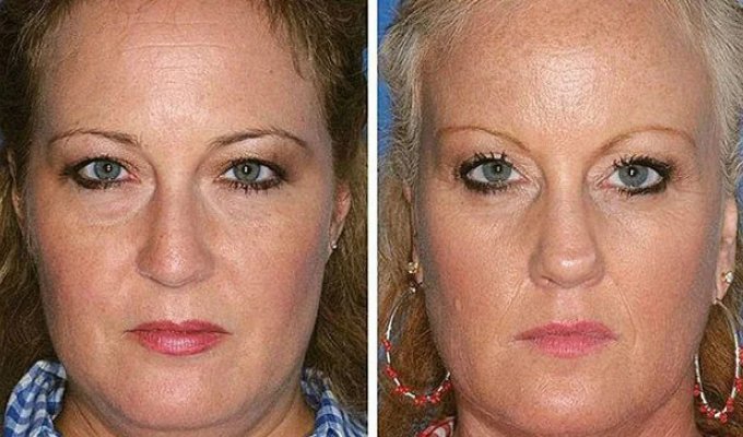 The visible effects of smoking as seen in identical twins (5 photos)