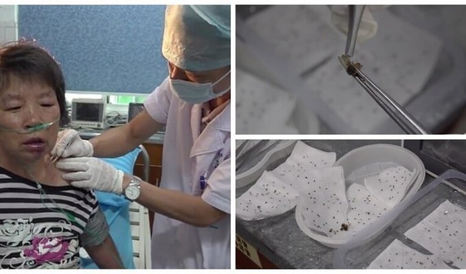 Из тела китаянки вытащили более 400 пчелиных жал (6 фото)