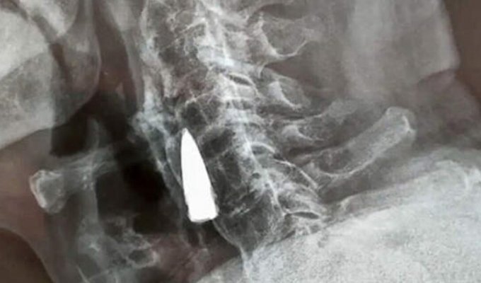The man found out about the bullet lodged in his body, 77 years later (3 photos)