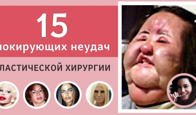 15 шокирующих неудач пластической хирургии (16 фото)