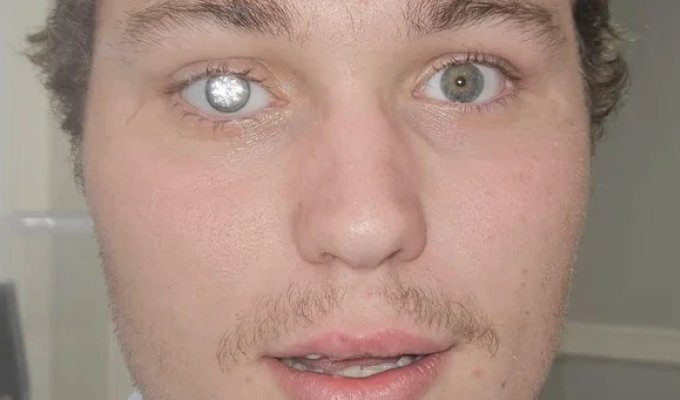 Владелец ювелирного магазина вставил в глаз бриллиант в 2 карата (5 фото + 1 видео)