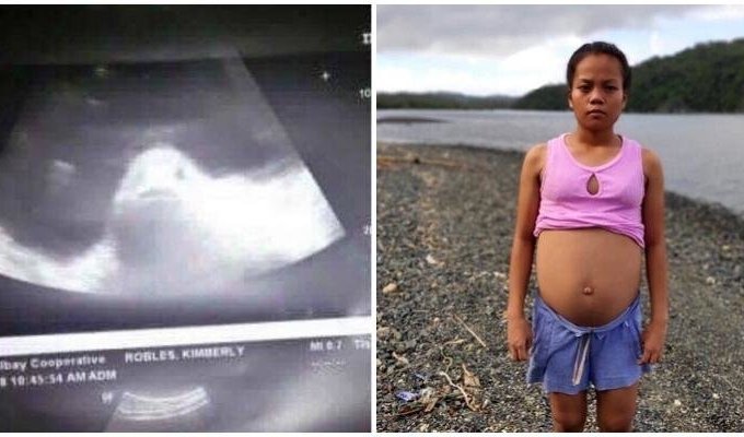 Жители Филиппинской провинции Албай верят, что 17-летняя девушка беременна рыбой (3 фото)