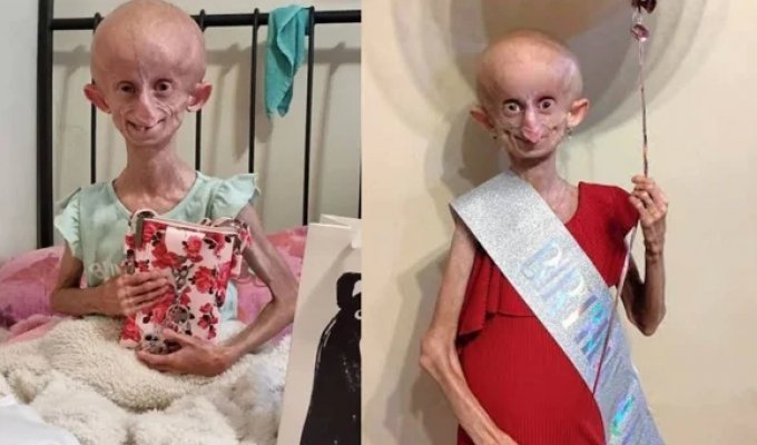 The girl lived only 19 years, but her biological age was approaching 152 years (6 photos)