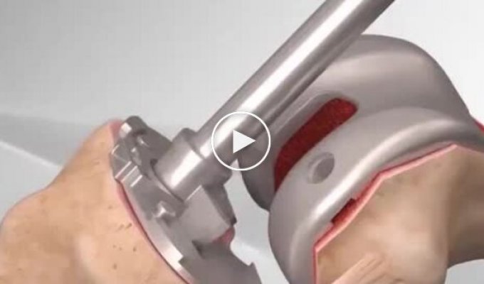 Складна система: Протезування колінного суглоба