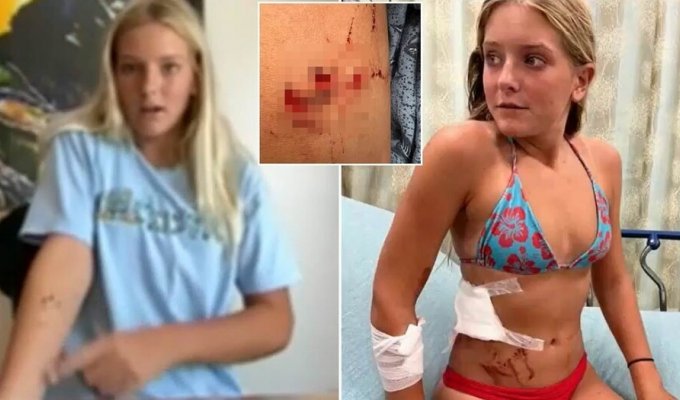 The schoolgirl was attacked twice by a shark, but the girl managed to fight back (3 photos + 1 video)
