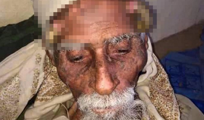 140-річний йеменець помер після видалення рогів. Кажуть, вони виросли після операції з Дияволом (4 фото)