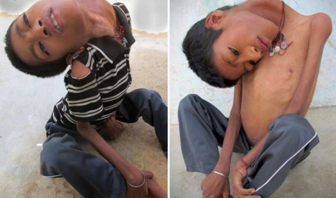 Полсотни индийских врачей не смогли понять, чем болен 12-летний мальчик с «резиновой» шеей (5 фото)