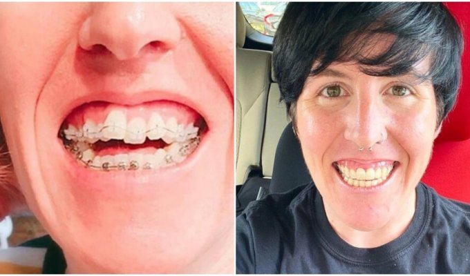 People who changed their lives when they took care of their teeth (13 photos)