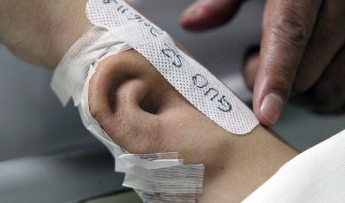 Китайские медики вырастили новое ухо для пострадавшего в аварии на его собственной руке (6 фото)
