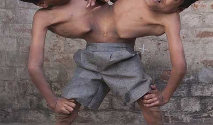 Сиамские близнецы в Индии стали новым божеством (5 фото)