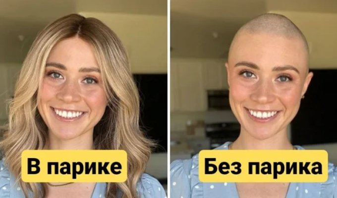 With and without a wig: women with alopecia who were able to overcome their complexes (12 photos)