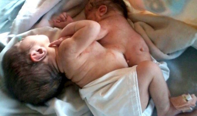 В Индии младенец родился с головой и руками близнеца-паразита, торчащими из груди (2 фото)