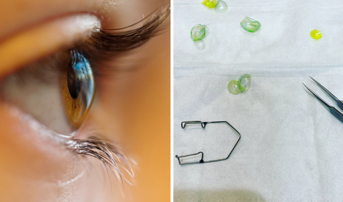 The doctor took out 23 contact lenses from the eye of a forgetful patient (4 photos + 1 video)