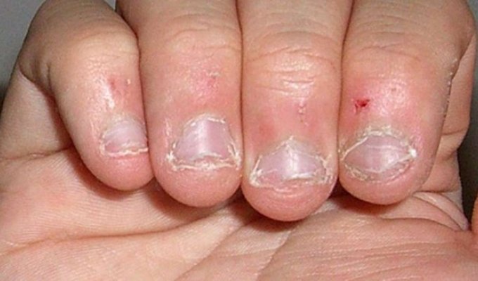 11 ужасающих фактов, которые навсегда заставят вас перестать грызть ногти (12 фото)