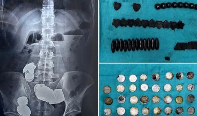 A bodybuilder from India swallowed 39 coins and 37 magnets (5 photos)