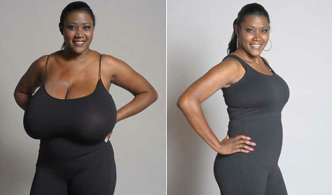 Хирурги четыре часа избавляли женщину от 14-килограммовой груди (6 фото)